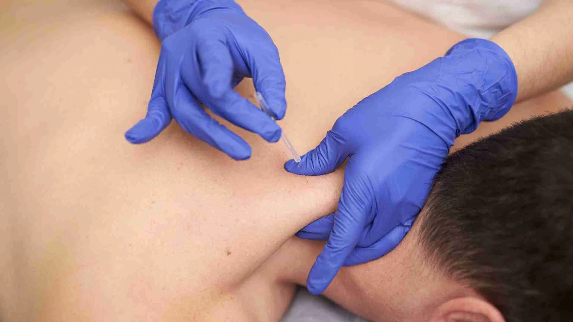 Therapist applying acupuncture needle to patient upper back to show benefits of dry needling therapy.